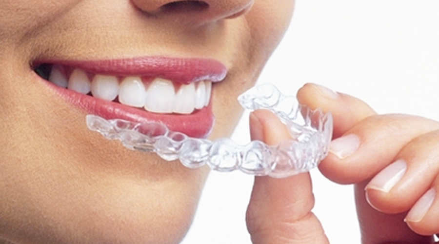 マウスピース矯正