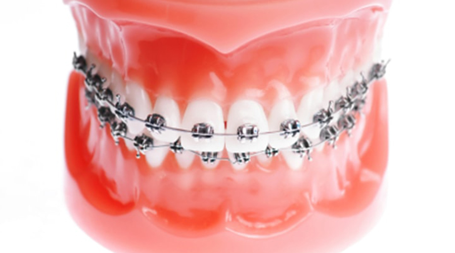 メタルブラケット矯正